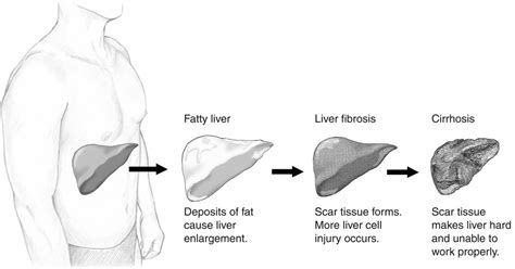 Liver Damage From Alcohol Learn The Symptoms In A Real Patient