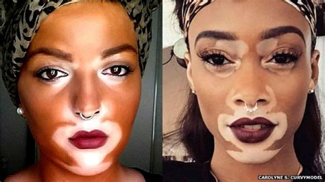 The Model Who S Bringing A Rare Skin Condition Into The Open BBC News