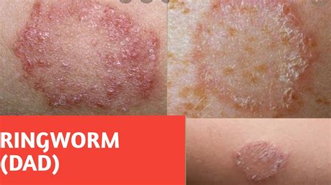 Ringworm Causes Symptoms Prevention Treatment Youtube
