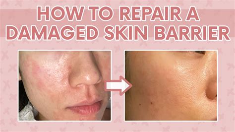 The Most Effective Method To Repair Your Damaged Skin Barrier Dr