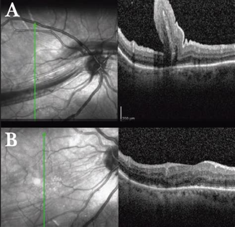 Retinatoday Management Of Retinal Folds After Rd