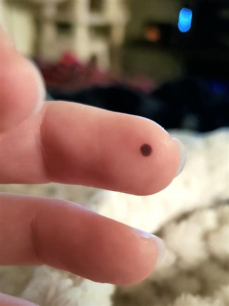My Blood Blister Is A Nearly Perfect Circle Rmildlyinteresting