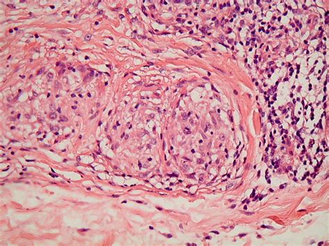 Sarcoidal Granulomas Are Found In Sarcoidosis And In Certain Types Of