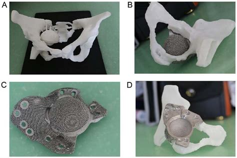 3d Printed Pelvic Model And Acetabulum Prosthesis Download