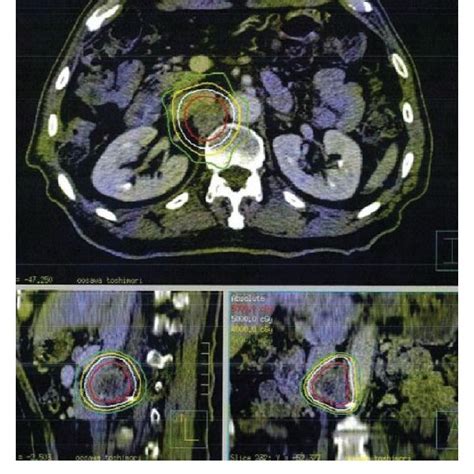 A Ct Of Left Supraclavicular Lymph Node Metastases Arrow Before