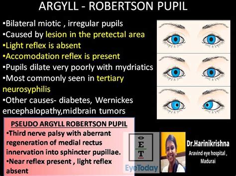 Pupilas De Argyll Robertson