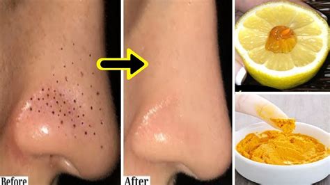 HOW TO REMOVE BLACKHEADS WHITEHEADS From Nose Face Naturally At Home By NaturalBeautyTips