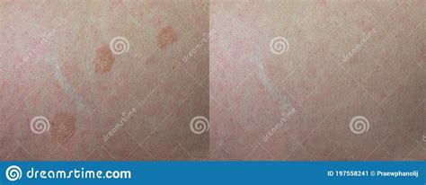 Close Up Before And After Treatment Skin Disease Tinea Versicolor