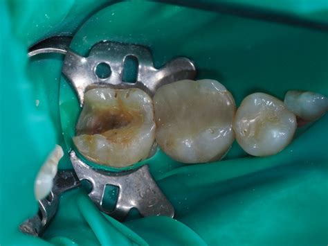 Beautiful Well Sealed Distal Restorations Dental Head Start