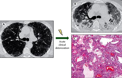 Idiopathic Pulmonary Fibrosis The Lancet