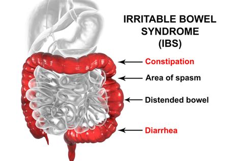 Irritable Bowel Syndrome Ibs Symptoms And Treatment Parkway East