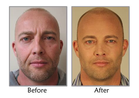 Another treatment that's high on the list of male plastic surgery procedures is the hair transplant. Non-Surgical Facelift At Thompson Facial Plastics