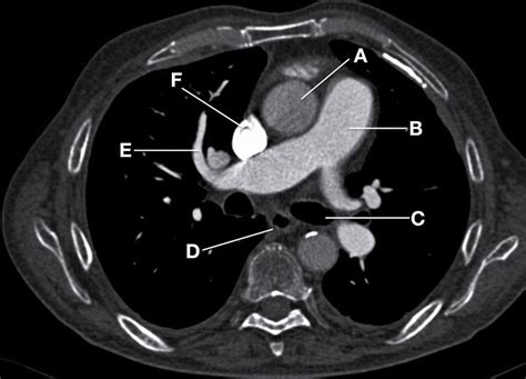 Axial Computed Tomography Pulmonary Angiogram The Bmj