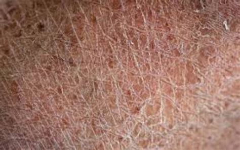 Causes And Treating Dry Skin And Patches Fast Skincarederm