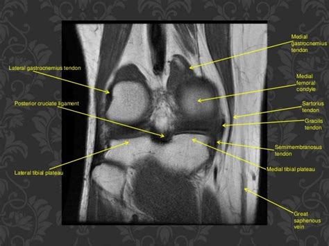 Mri Knee Of Orthopedic Importance