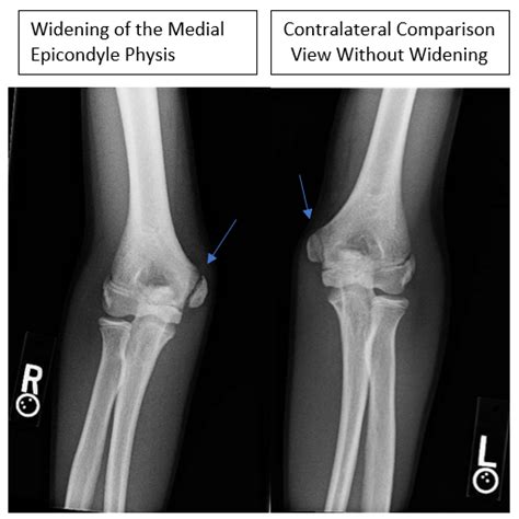 Medial Epicondyle Avulsion Fracturesapophysitis Elbow Surgery