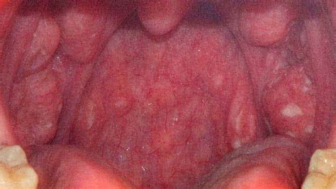 Constant Sore Throat Without Tonsils Redis
