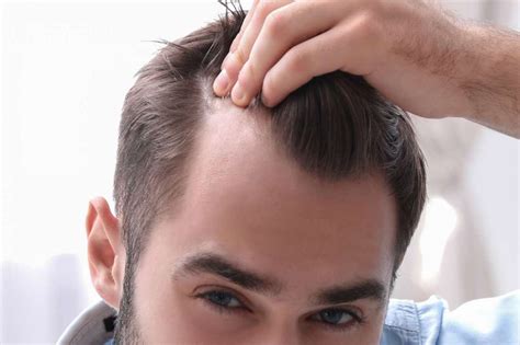 Receding Hairline Why It Happens And How To Fix It Insalaco Clinic
