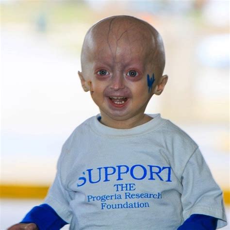 The Making Of The Mutation Story Part 2 Hutchinsongilford Progeria