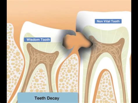 Wisdom Teeth Pain Infection Or Decay Why Third Molars Are Extracted