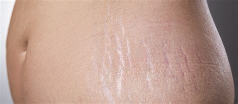 stretch marks eliminate them naturally and quickly keys of health