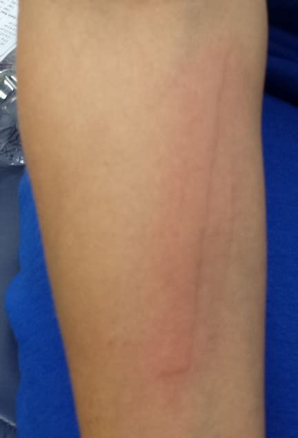 Superdrug Health Clinic Red Lines On Skin That Look Like Scratches