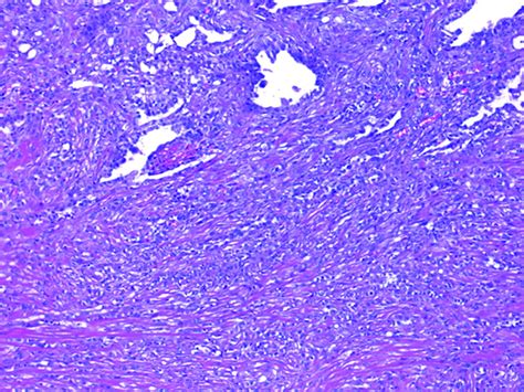 Check spelling or type a new query. Biphasic Malignant Pleural Mesothelioma