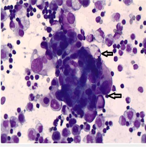 Ascitic Fluid Cytology Finding Consistent With Adenocarcinoma Shown By