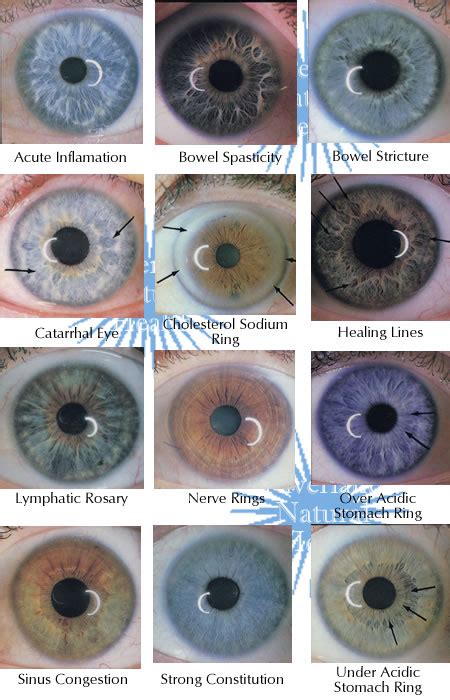 Heres A Quick Way To Iridology Chart How To Read Iriscope