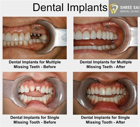 Toothfairytime OralHealthTeeth Dental Implants Tooth Implant Cost