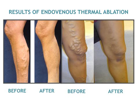 Endovenous Thermal Ablation Treatment In Mumbai Dr Avinash Katara