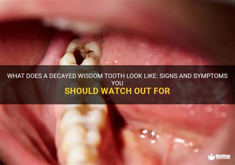 What Does A Decayed Wisdom Tooth Look Like Signs And Symptoms You