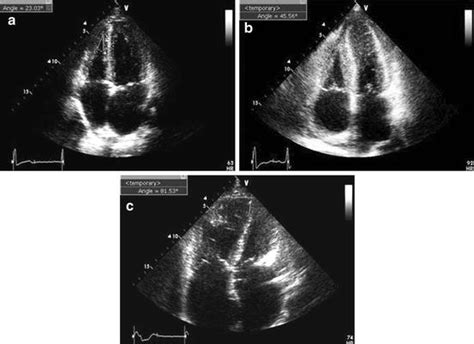 Echocardiography Of Chronic Right Heart Failure Thoracic Key