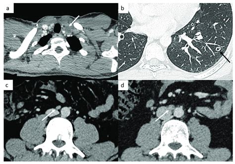 Small Disease Thoracic Ct Reveals A Small Left Supraclavicular Lymph