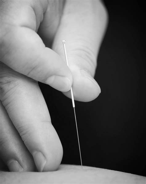 Effective Dry Needling Or Medical Acupuncture For The Treatment Of