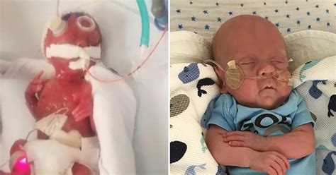 Baby Born At 22 Weeks Was Rejected By 15 Hospitals Because He Wont