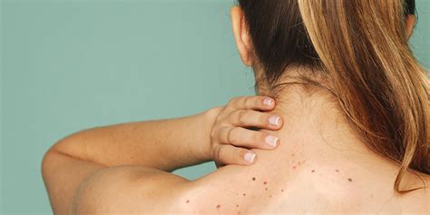 Black Spots On Back Neck And Shoulders Causes And Treatment