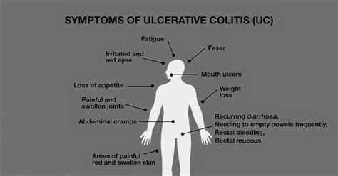 Symptoms Of Ulcerative Colitis Pt Master Guide
