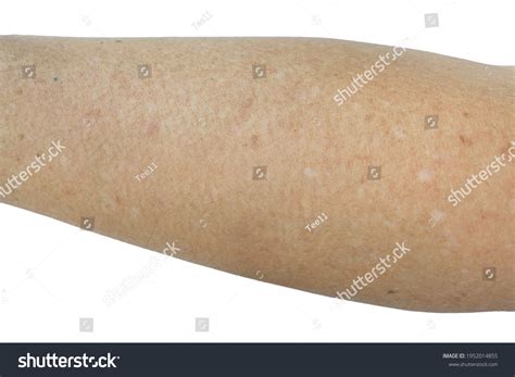 Small White Spots On Arms Idiopathic Stock Photo Edit Now 1952014855