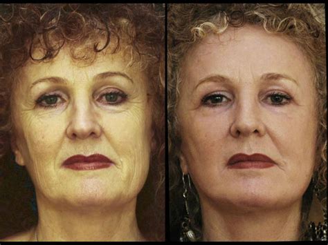Full Face Laser Facial Treatment Before After Gainesville Face Lift