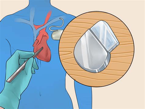 How can i prevent tachycardia/tachycardia conventionally but arbitrarily defined as an atrial and/or ventricular rate of >100 beats per minute, is encountered commonly and can be physiological or pathological in origin. How to Treat Tachycardia: 10 Steps (with Pictures) - wikiHow