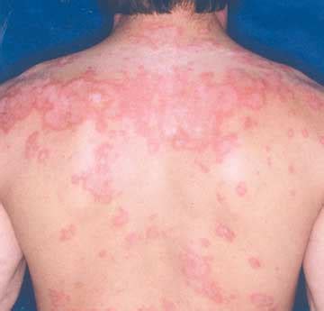 Check spelling or type a new query. Lupus in Düsseldorf - Bilder, News, Infos aus dem Web