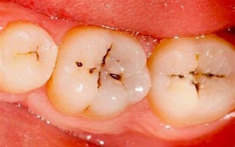 齲齒：牙齒蛀牙的原因、症狀和治療 ｜常見口腔問題與治療｜快樂牙齒
