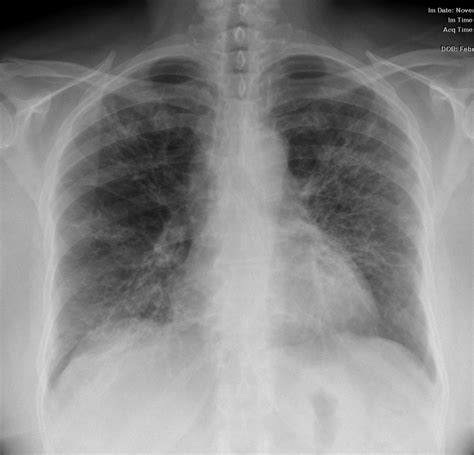 000 Usual Interstitial Pneumonia Uip Lungs