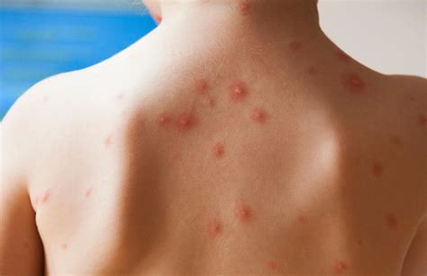 Today, a vaccine is available that protects children against chickenpox. Treatment of Chickenpox That You Need To Know - The ...