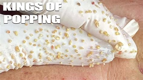 Queens Of Pimples And Kings Of Popping Hien Nguyen Best Asian Spa