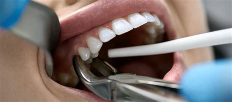 Check out our painless and easy methods for pulling out a. Tooth Extraction: When Will Dentists Pull Teeth? - Dr. Varley