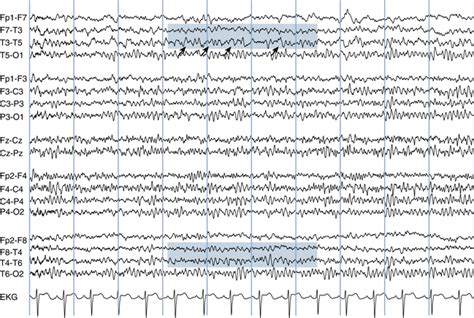 The Abnormal Eeg Neupsy Key