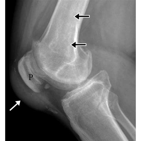 Gout Involving Intra Articular Popliteus Tendon In The Knee Coronal