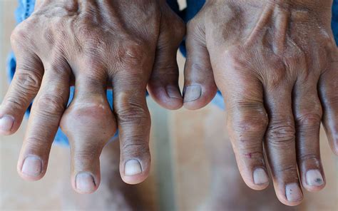 Pour écrire les nombres en toutes lettres sans fautes d'orthographe. Arthrose, arthrite et polyarthrite : quelles différences ? | Dossier